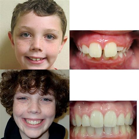 Before & After Braces | Wazio Orthodontics