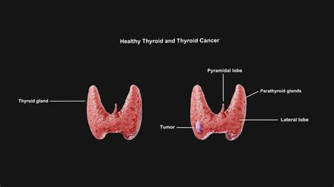 Thyroid 3D models - Sketchfab