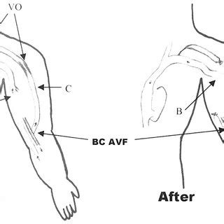 Basilic vein (B) transposition VV for long segment proximal VO of an... | Download Scientific ...