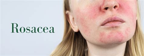 Rosacea Symptoms, Triggers, and Soothing Your Skin – GreenfieldBotanics