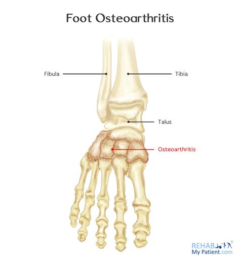 Foot Osteoarthritis | Rehab My Patient