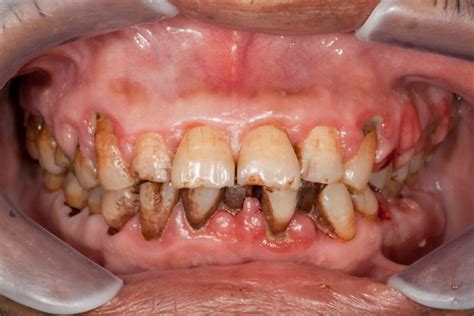 The Difference Between Plaque and Tartar