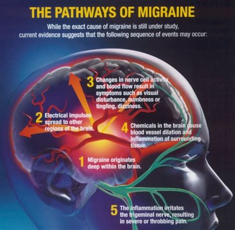 A Migraine Prevention Treatment on the Horizon | MyBrainTest