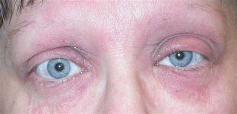 Eyelid Dermatitis (xeroderma of the eyelids, eczema of the eyelids, atopic dermatitis, allergic ...