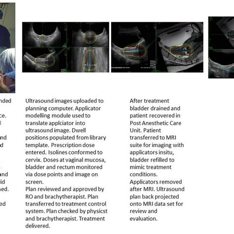 Fig A1. Overview of brachytherapy procedure. Source: Peter MacCallum ...