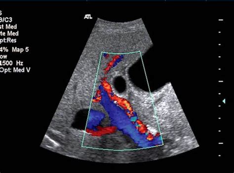 Fetal Portal Vein Ultrasound