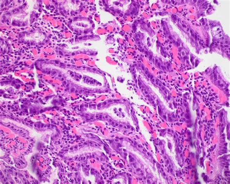 Portal Hypertension Histology