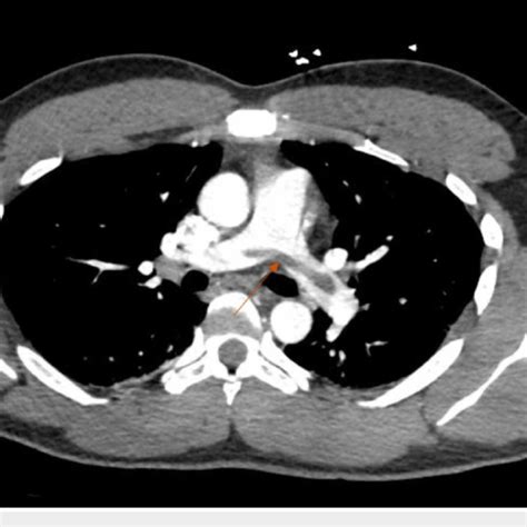 A CT angiography of the chest showing a large saddle pulmonary embolism... | Download Scientific ...