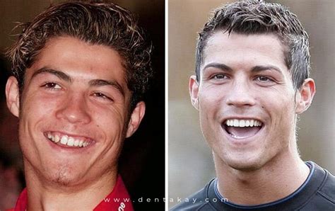 Ronaldo's teeth and smile makeover - Dentakay