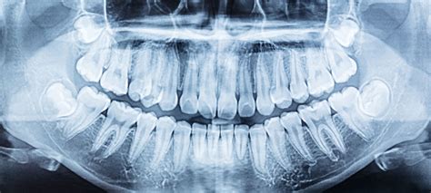 Wisdom tooth extraction at dental clinic and practice in Victoria ...