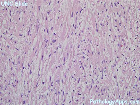 fibromatosis pathology