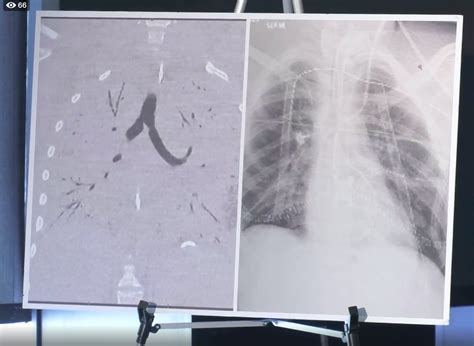 A Teen's Lungs Were So Badly Damaged from Vaping, He Needed A Double Lung Transplant | Live Science