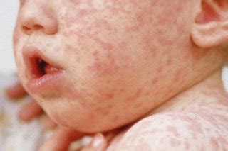 Rashes in babies and children - NHS