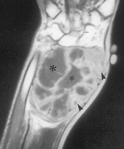 Imaging of Giant Cell Tumor and Giant Cell Reparative Granuloma of Bone: Radiologic-Pathologic ...