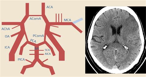 Bamford/Oxford classification of ischemic stroke | STROKE MANUAL