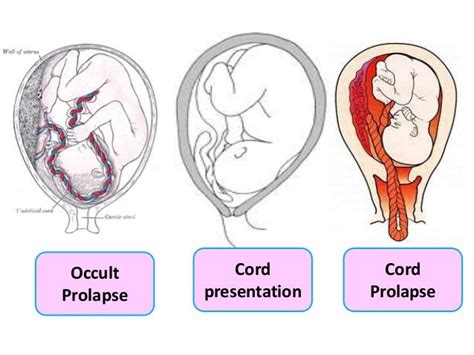 Cord pn+vasa praevia+afe