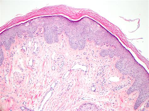 Fibrous Papule Histology