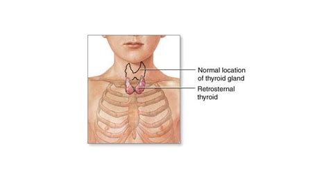 Substernal Thyroid | Mount Sinai - New York