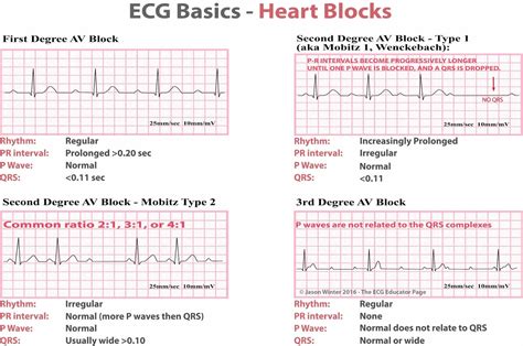 Ekg Heart Rate Blocks