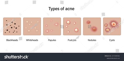 Nodule Skin