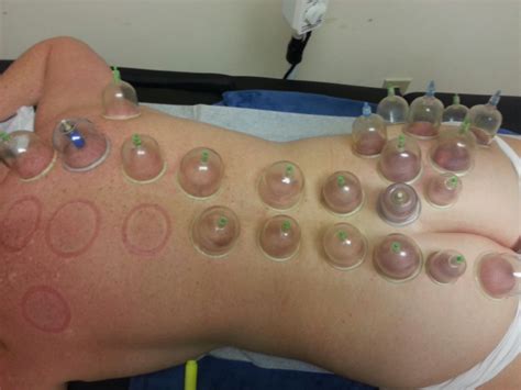 Cupping treatment relieves back pain and stress | Peachtree Corners, GA ...