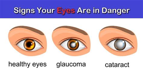 5 Warning Signs Your Eyes Are in Danger - WomenWorking | Healthy eyes, Eye facts, Eye health