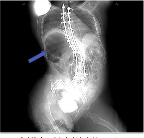 Figure 1 from Cecal volvulus with gangrene following Mitrofanoff ...