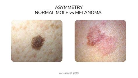 Benign Nevus Vs Melanoma