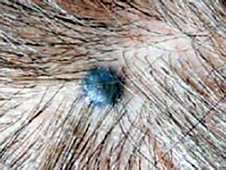 Melanocytic Nevi - Cellular Blue Nevus | Perri Dermatology