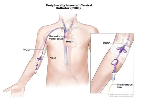 PICC Line Insertion | Varicose veins | Vascular surgeon | Stroke | DVT ...