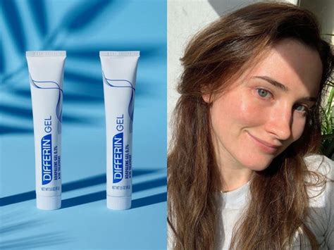 Differin Acne Gel Review: How It Helped Clear up My Skin