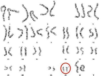 DiGeorge syndrome (22q11.2 deletion syndrome) - The Oncofertility ...