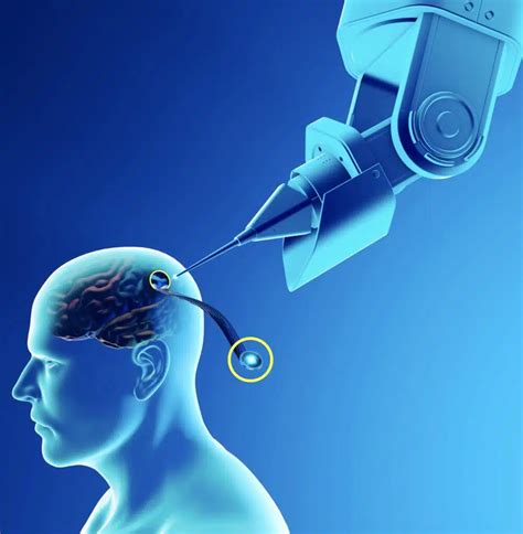 Musk calls on volunteers for first Neuralink brain chip