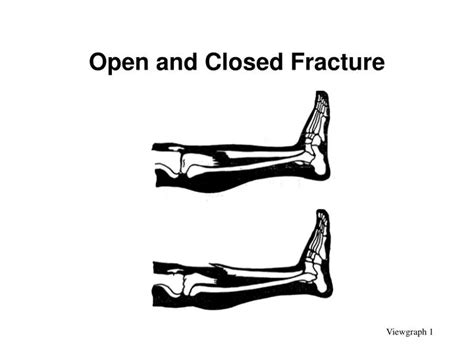 Closed fracture - hometraffic