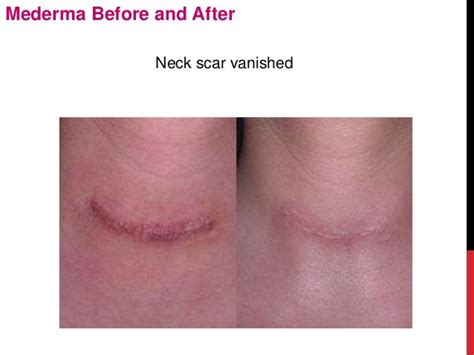 Mederma before-and-after