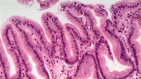 Chemical gastropathy (stomach) - MyPathologyReport.ca