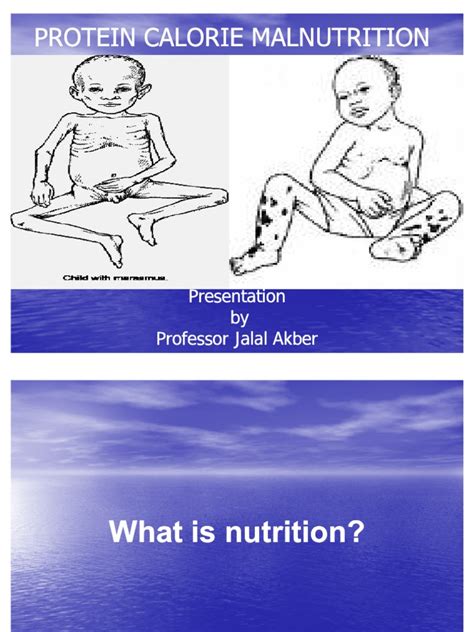 Protein Calorie Malnutrition | PDF | Malnutrition | Medicine