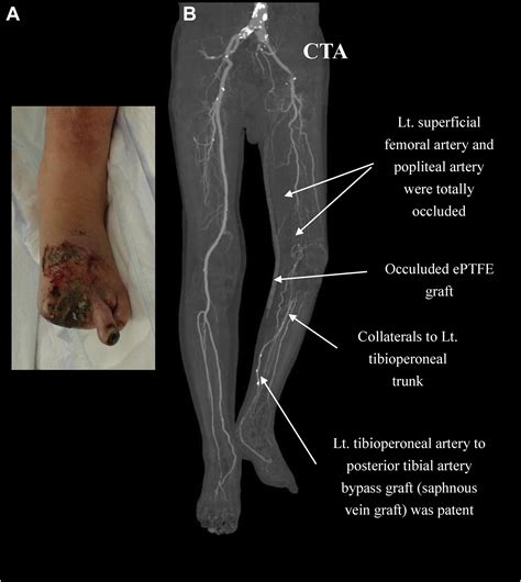 Popliteal Artery And Vein