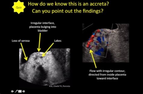 Placenta Percreta Ultrasound