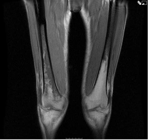 MRI scan showed an increased marrow signal in the distal femur and ...