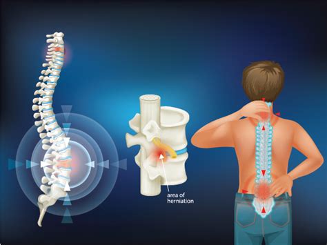 All You Should Know About Spinal Cord Injury