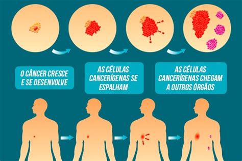 Metástasis: qué es, síntomas y cómo ocurre - Tua Saúde