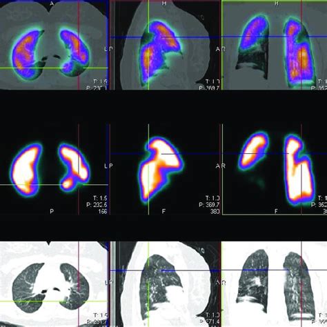 Perfusion single-photon emission computed tomography/computed ...