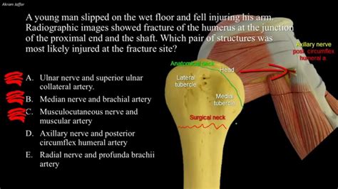 Proximal Humerus Fracture Associated With Delayed Axillary Nerve Injury ...