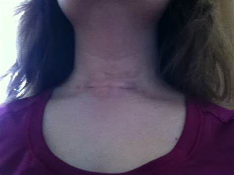 My Thyroidectomy: A Personal Account: Scar - 20 days post thyroidectomy