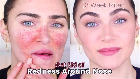 How To Get Rid Of Redness Around Nose - Health For Best Life