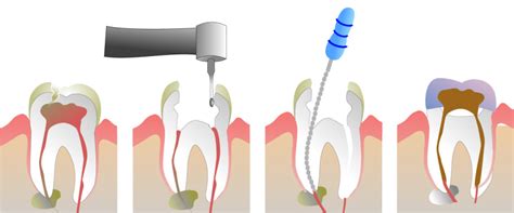 Post-Op Recovery for Root Canal Surgery | Gastonia Family Dentistry