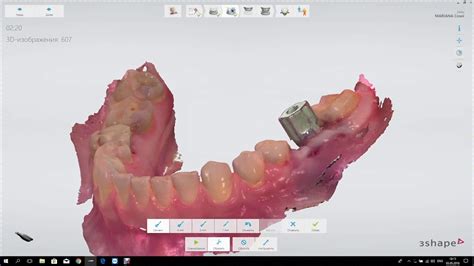 3shape implant scan - YouTube