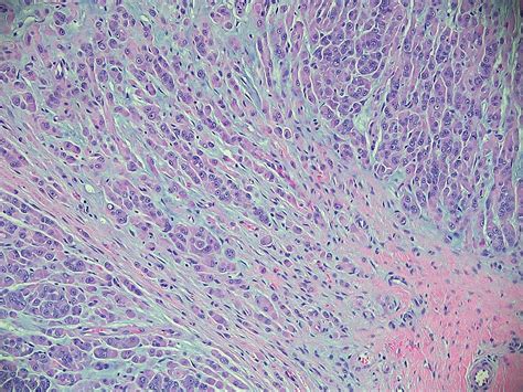 Mpnst Histology