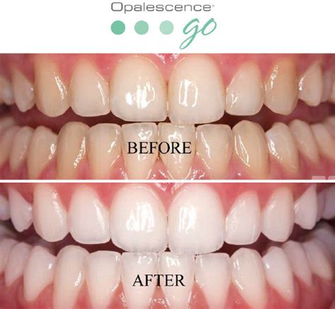Teeth Whitening Services in Norman, OK | Norman Smile Center